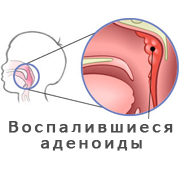 Аденоиды