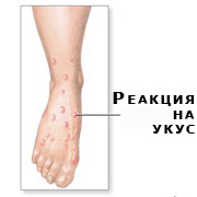 Аллергия на укусы насекомых Аллергия на укусы насекомых