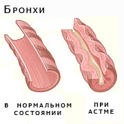 Бронхиальная астма Бронхиальная астма