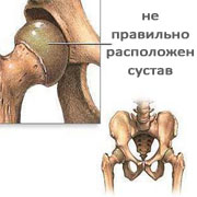 Дисплазия тазобедренного сустава