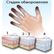 Симптомы обморожения, стадии обморожения Симптомы обморожения, стадии обморожения