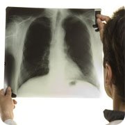 Туберкулез